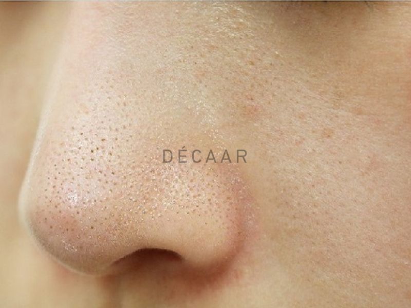 da mặt sần sùi nhiều mụn cám